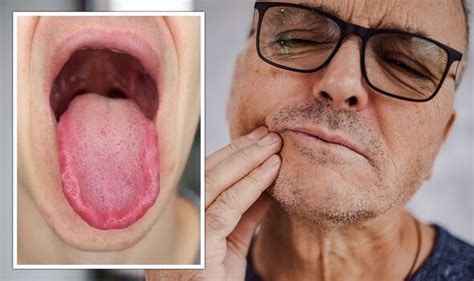 'Burning mouth' syndrome could reveal several underlying health ...