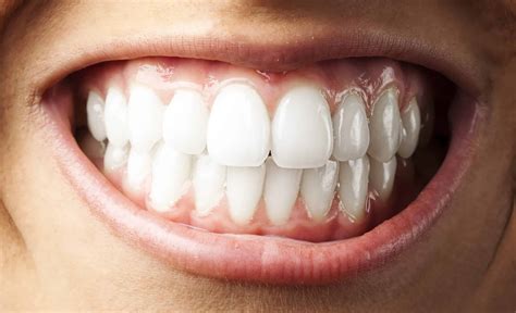 How Is Your Bite Supposed to Look? - Wilkinson Dental