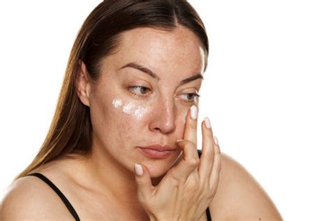 Melasma Images – Browse 3,704 Stock Photos, Vectors, and Video | Adobe ...