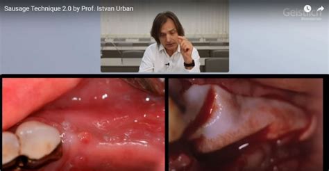 Sausage Technique 2.0 by Prof. Istvan Urban - Be International Dental ...