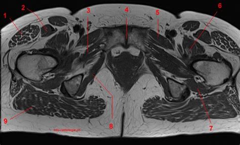 MRI of the Hip: Detailed Anatomy - W-Radiology